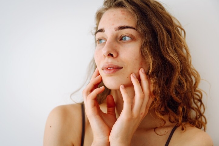 Acne treatment