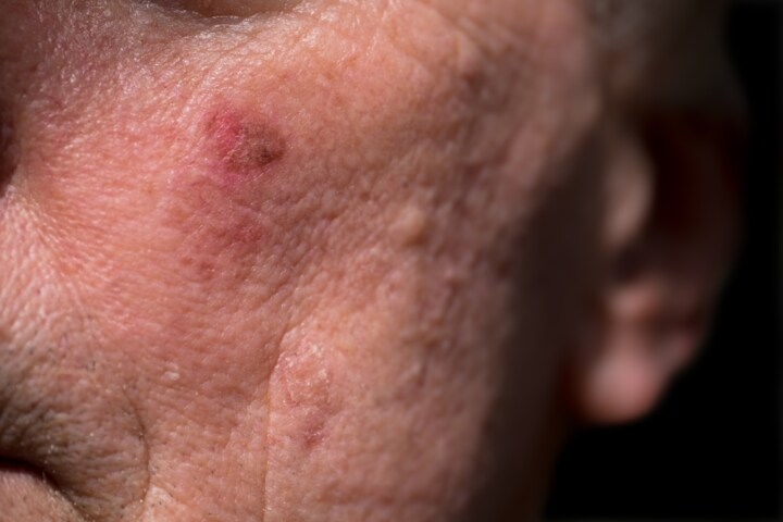 sun damaged skin