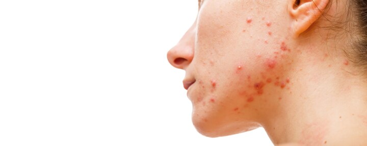 Skintechmedical com au medical and skin clinic acne treatments