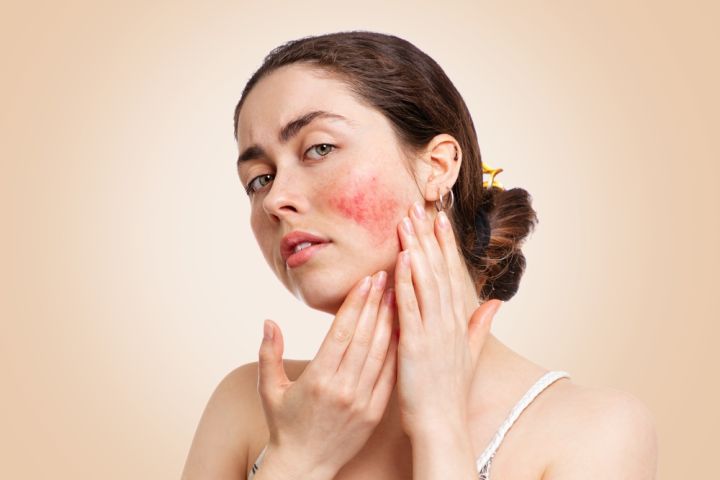 Skintechmedical com au medical and skin clinic rosacea overview symptoms and treatment