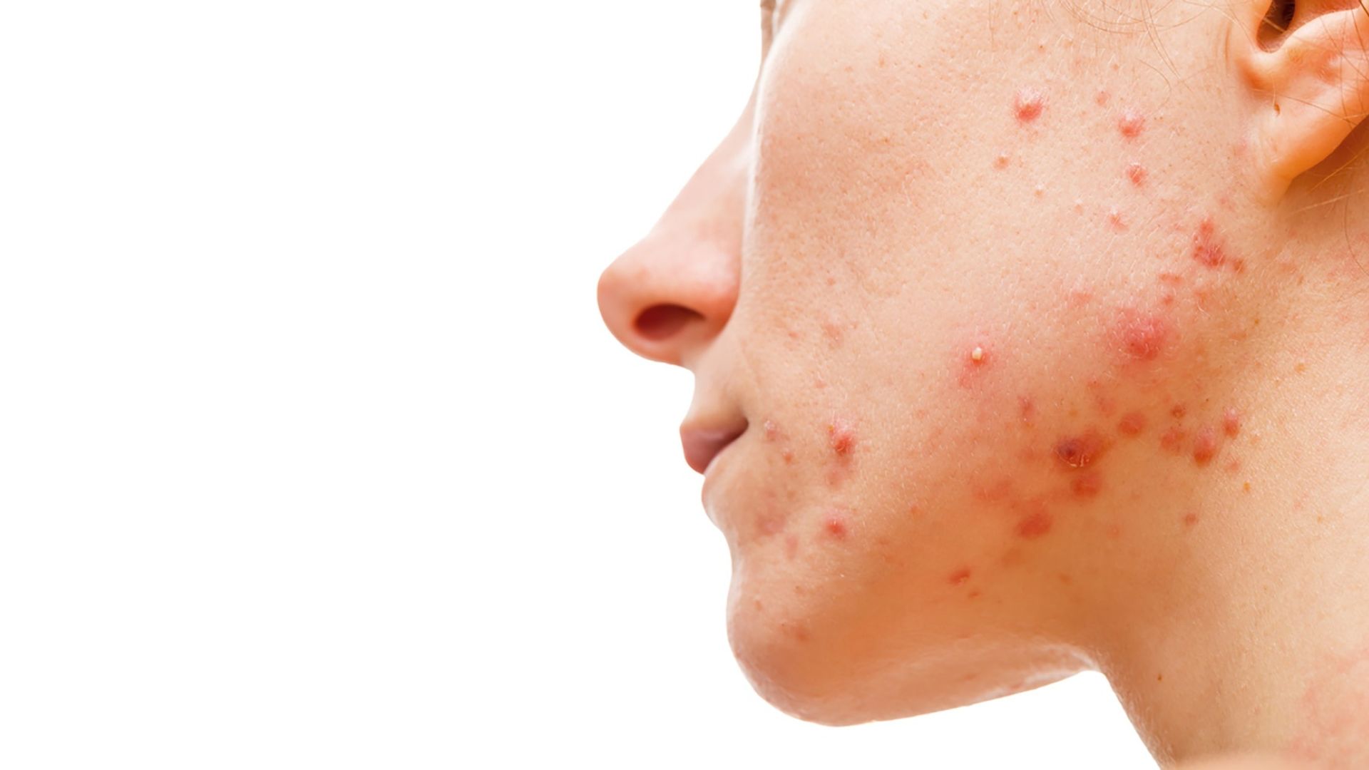 Skintechmedical com au medical and skin clinic acne treatments