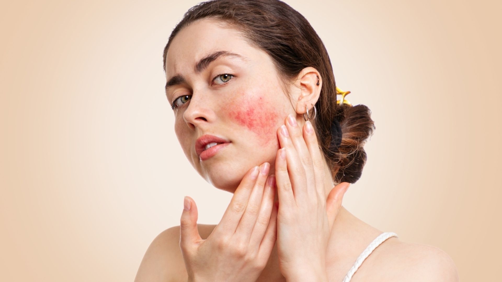 Skintechmedical com au medical and skin clinic rosacea overview symptoms and treatment