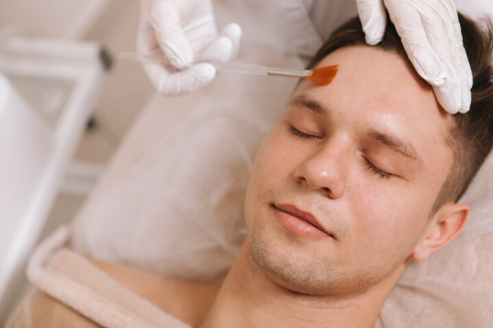 face skin peel treatment